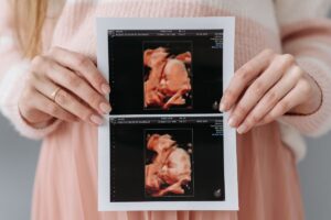 Leia mais sobre o artigo Ultrassom 5D: a tecnologia perfeita para você ver o rostinho do seu bebê